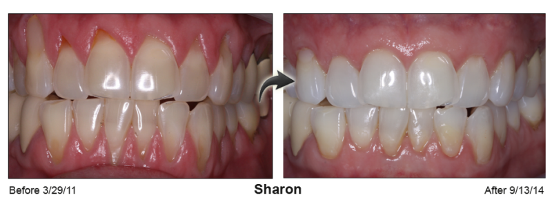 Pinhole Gum Rejuvenation™ Before & After